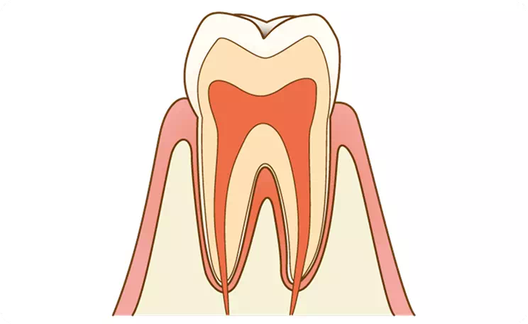 【C0】初期段階の虫歯のイメージ画像