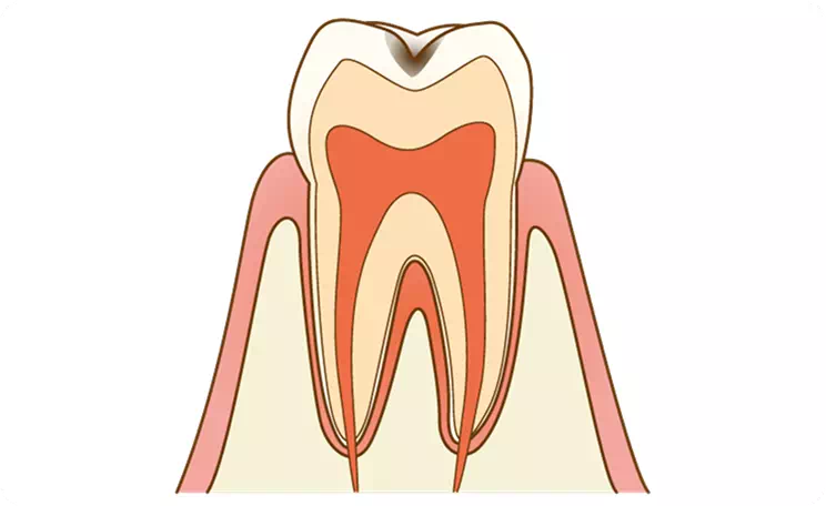 【C1】エナメル質の虫歯のイメージ画像