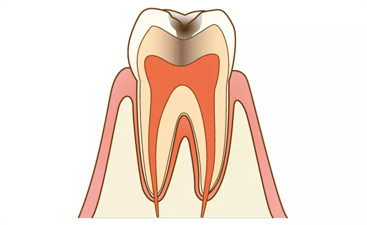 【C2】象牙質の虫歯のイメージ画像