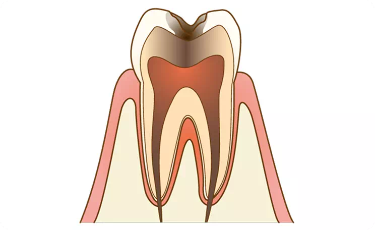 【C3】神経まで達した虫歯のイメージ画像