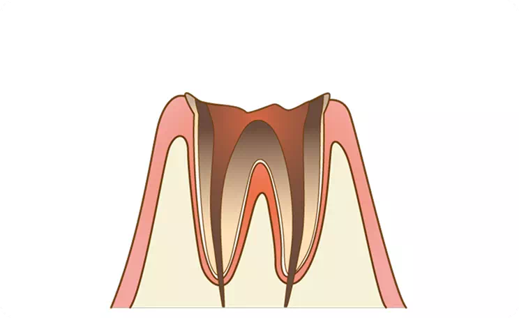 【C4】歯根まで達した重度の虫歯のイメージ画像