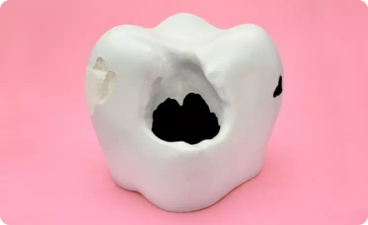 虫歯のイメージ画像