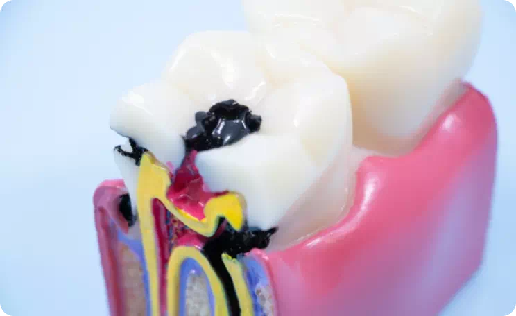 虫歯のイメージ画像