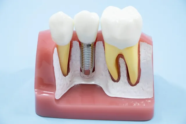 GBR（骨誘導再生法）のイメージ画像