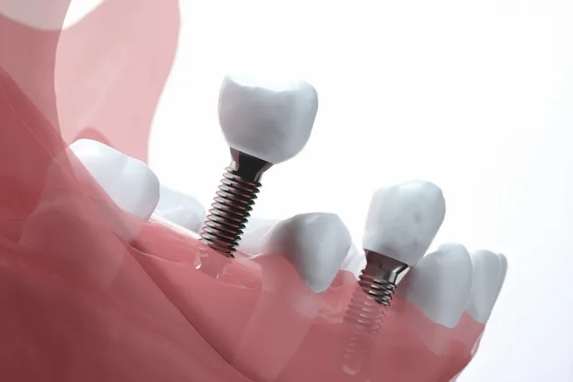 インプラントのイメージ画像