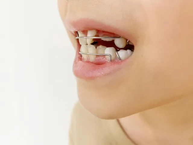 矯正途中の画像