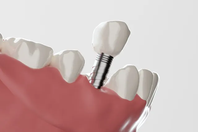 ソケットリフトのイメージ画像